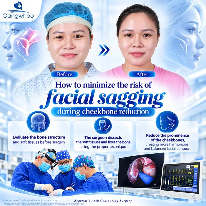 Does Cheekbone Reduction Cause Facial Sagging? Why Does Sagging Happen?