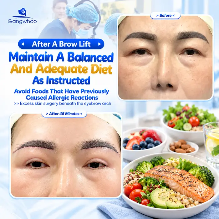 What Not to Eat After a Brow Lift? What to Eat to Support Recovery?