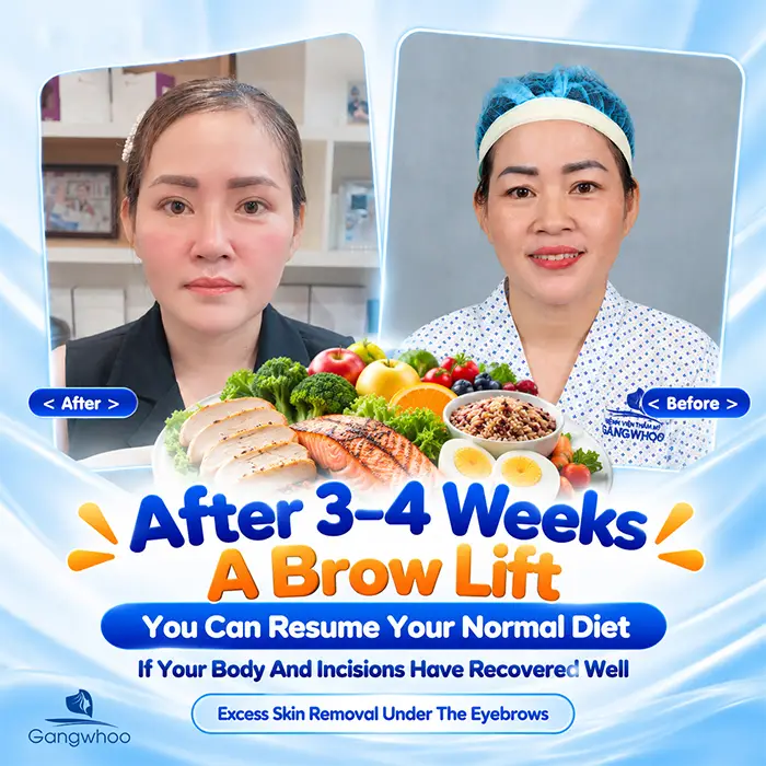 What Not to Eat After a Brow Lift? What to Eat to Support Recovery?